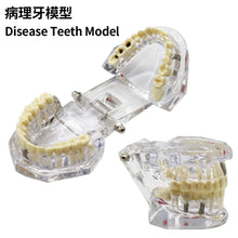 Cargar imagen en el visor de la galería, HRRSDental Implant Dental Disease Teeth Model With Restoration Bridge Tooth For Medical Science Dental Disease Teaching Study Tool
