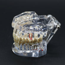 Загрузить изображение в средство просмотра галереи, HRRSDental Implant Dental Disease Teeth Model With Restoration Bridge Tooth For Medical Science Dental Disease Teaching Study Tool
