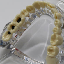 Load image into Gallery viewer, HRRSDental Implant Dental Disease Teeth Model With Restoration Bridge Tooth For Medical Science Dental Disease Teaching Study Tool
